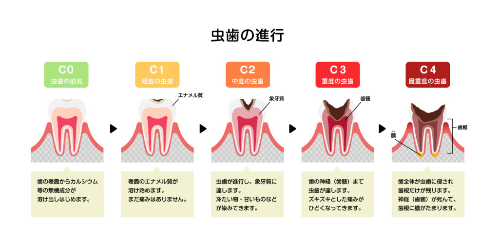 虫歯の進行と症状